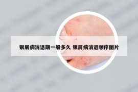 銀屑病消退期一般多久 銀屑病消退順序圖片