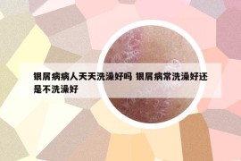 銀屑病病人天天洗澡好嗎 銀屑病常洗澡好還是不洗澡好