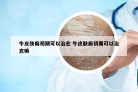 牛皮膚癬初期可以治愈 牛皮膚癬初期可以治愈嘛