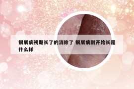銀屑病初期長了的消除了 銀屑病剛開始長是什么樣