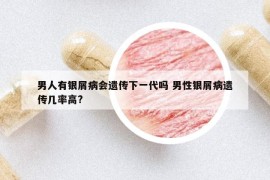男人有銀屑病會遺傳下一代嗎 男性銀屑病遺傳幾率高?