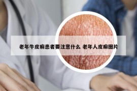 老年牛皮癬患者要注意什么 老年人皮癬圖片
