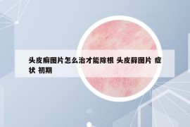 頭皮癬圖片怎么治才能除根 頭皮蘚圖片 癥狀 初期
