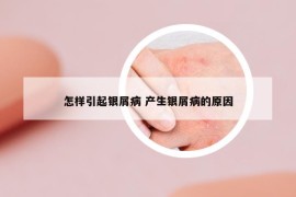 怎樣引起銀屑病 產(chǎn)生銀屑病的原因