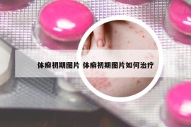 體癬初期圖片 體癬初期圖片如何治療