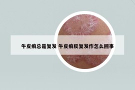 牛皮癬總是復(fù)發(fā) 牛皮癬反復(fù)發(fā)作怎么回事