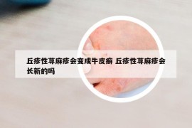 丘疹性蕁麻疹會變成牛皮癬 丘疹性蕁麻疹會長新的嗎