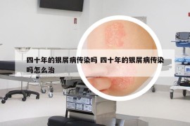四十年的銀屑病傳染嗎 四十年的銀屑病傳染嗎怎么治