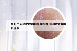 蘭州二大的皮膚病銀屑病醫(yī)院 蘭州皮膚病?？漆t(yī)院