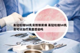 氟輕松維b6乳膏擦銀屑病 氟輕松維b6乳膏可以治療真菌感染嗎