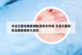 卡泊三醇治銀屑病能用多長(zhǎng)時(shí)間 卡泊三醇軟膏治銀屑病多久有效