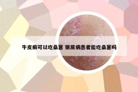 牛皮癬可以吃桑葚 銀屑病患者能吃桑葚嗎