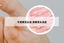 午皮癬怎么治 皮癬怎么治愈