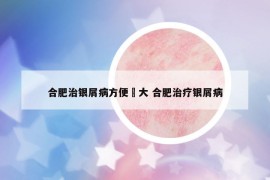 合肥治銀屑病方便軍大 合肥治療銀屑病