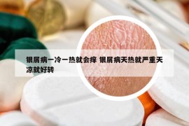銀屑病一冷一熱就會癢 銀屑病天熱就嚴重天涼就好轉(zhuǎn)
