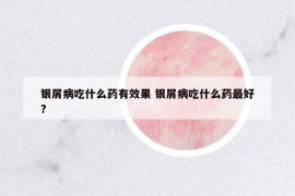 銀屑病吃什么藥有效果 銀屑病吃什么藥最好?