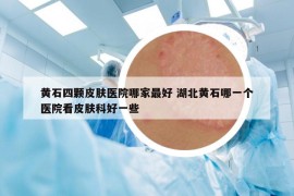 黃石四顆皮膚醫(yī)院哪家最好 湖北黃石哪一個醫(yī)院看皮膚科好一些