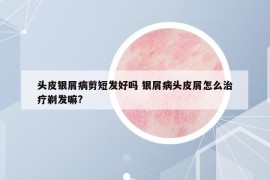 頭皮銀屑病剪短發(fā)好嗎 銀屑病頭皮屑怎么治療剃發(fā)嘛?