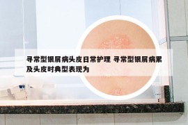 尋常型銀屑病頭皮日常護理 尋常型銀屑病累及頭皮時典型表現(xiàn)為