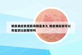 銀屑病皮膚更新周期是多久 銀屑病皮膚可以恢復(fù)到以前那樣嗎