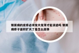 銀屑病的皮疹必須變大變薄才能消退嗎 銀屑病疹子面積擴大了是怎么回事
