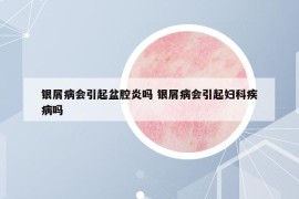 銀屑病會引起盆腔炎嗎 銀屑病會引起婦科疾病嗎