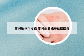 章丘治療牛皮癬 章丘皮膚病?？漆t(yī)醫(yī)院