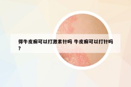 得牛皮癬可以打激素針嗎 牛皮癬可以打針嗎?