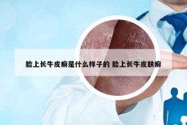 臉上長牛皮癬是什么樣子的 臉上長牛皮膚癬
