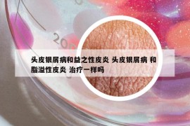 頭皮銀屑病和益之性皮炎 頭皮銀屑病 和 脂溢性皮炎 治療一樣嗎