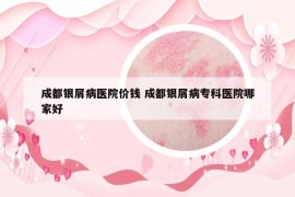成都銀屑病醫(yī)院價錢 成都銀屑病專科醫(yī)院哪家好