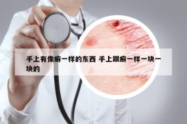 手上有像癬一樣的東西 手上跟癬一樣一塊一塊的