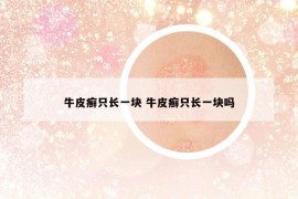牛皮癬只長(zhǎng)一塊 牛皮癬只長(zhǎng)一塊嗎