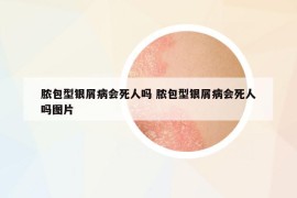 膿包型銀屑病會(huì)死人嗎 膿包型銀屑病會(huì)死人嗎圖片