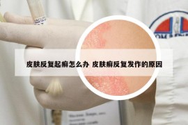 皮膚反復(fù)起癬怎么辦 皮膚癬反復(fù)發(fā)作的原因