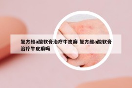 復方維a酸軟膏治療牛皮癬 復方維a酸軟膏治療牛皮癬嗎