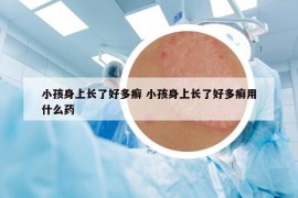 小孩身上長了好多癬 小孩身上長了好多癬用什么藥