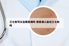 三七粉可以治銀屑病嗎 銀屑病人能吃三七粉嗎