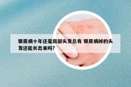 銀屑病十年還是局部頭發(fā)總有 銀屑病掉的頭發(fā)還能長出來嗎?