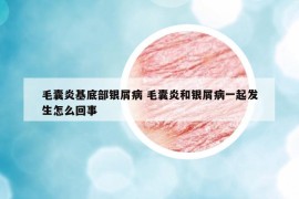 毛囊炎基底部銀屑病 毛囊炎和銀屑病一起發(fā)生怎么回事
