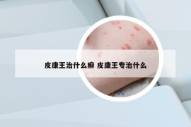 皮康王治什么癬 皮康王專治什么