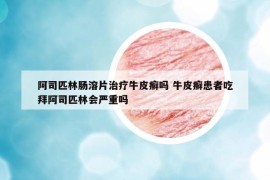 阿司匹林腸溶片治療牛皮癬嗎 牛皮癬患者吃拜阿司匹林會嚴(yán)重嗎