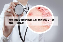 襠旁邊有個(gè)圓形的癬怎么辦 襠邊上長(zhǎng)了一片疙瘩 一碰就癢