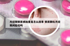 月經期銀屑病加重是怎么回事 銀屑顆粒月經期間能吃嗎