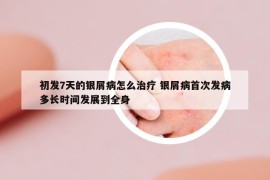 初發(fā)7天的銀屑病怎么治療 銀屑病首次發(fā)病多長時間發(fā)展到全身
