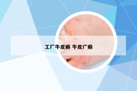 工廠牛皮癬 牛皮廣癬