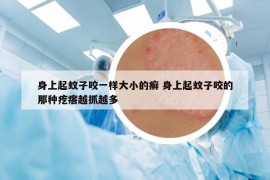 身上起蚊子咬一樣大小的癬 身上起蚊子咬的那種疙瘩越抓越多