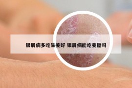 銀屑病多吃生姜好 銀屑病能吃姜糖嗎