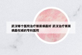 武漢哪個(gè)醫(yī)院治療銀屑病最好 武漢治療銀屑病最權(quán)威的?？漆t(yī)院