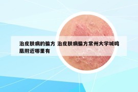 治皮膚病的偏方 治皮膚病偏方常州大學(xué)城鳴凰附近哪里有